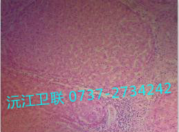 門(mén)脈性肝硬化